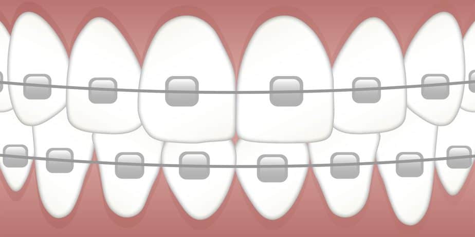 https://www.arie-stomatologia.pl/wp-content/uploads/2014/06/aparat-ortodontyczny-darmowy-obraz-z-pixabay-1280x640.jpg